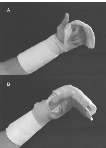 FIGURE 5. (A) Cast for multiple metacarpal fractures permitting early active finger flexion; (B) resting volar component added to maintain interphalangeal joints in full extension.