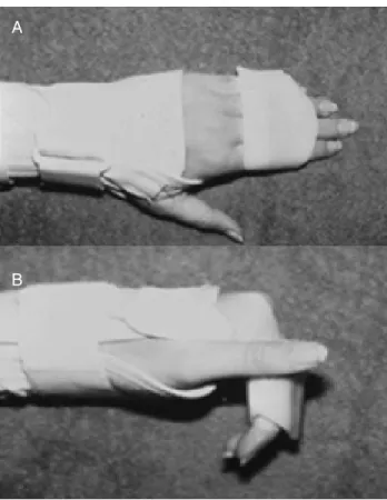 FIGURE 6. (A) Wrist and distal joint immobilizer splint used during exercise sessions to promote flexion at the metacarpophalangeal joint (MP); (B) MP joint flexion isolated during exercise with use of dual blocking splints.