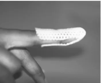 FIGURE 11. Tip protector splint bivalved to maintain distal interphalangeal joint (DIP) extension and accommodate swelling for mallet fractures.