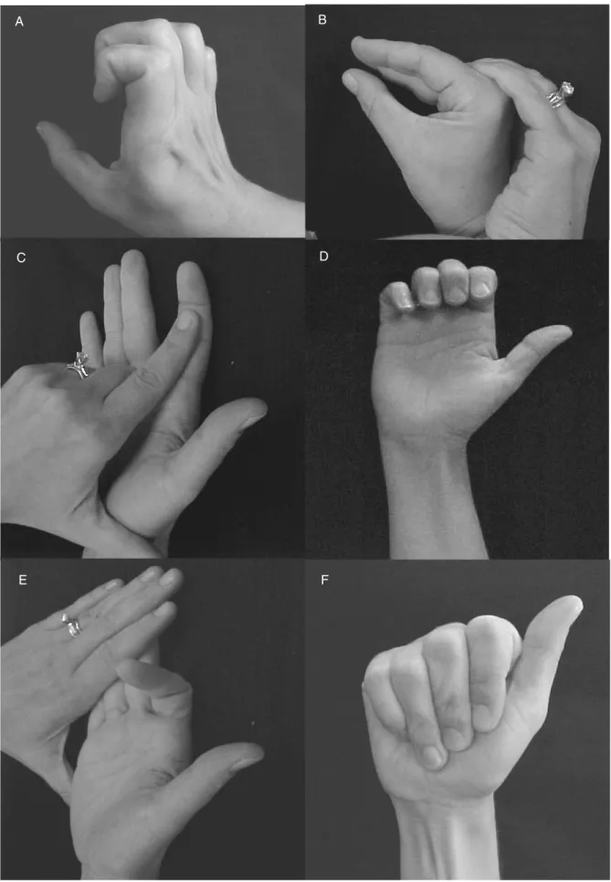 FIGURE 2. Tendon glide exercises: (A) claw posture to achieve extensor digitorum communis (EDC) tendon glide over metacarpal bone; (B) intrinsic plus posture to achieve central slip/lateral bands glide over proximal phalanx (P1); (C) flexor digitorum profu