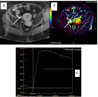 Figure 2. 65 years old female patient presented with excessive vaginal bleeding. (A&B) Axial T1WI and sagittal T2WI showed endometrial soft tissue mass appearing isointense in T1 WI and high SI at T2SI