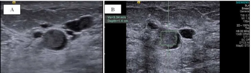 Figure 6. B mode ultrasound: (A) A well defined rounded solid soft tissue mass in a retro-areolar duct
