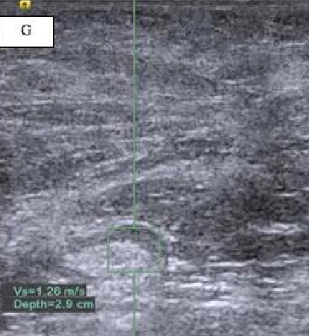 Table 1. Pathologic diagnosis in 142 patients with solid breasr masses. 