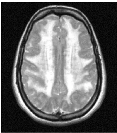 Fig. 1 A typical pattern of distribution of white matter hyperinten-sities in a T2 MRI of a 42-year-old woman affected by CADASIL