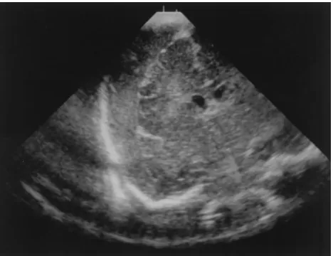 Fig 1. Head ultrasound on the first day of life. Coronal ultra-sound image obtained through the anterior fontanel demonstratesmixed echogenicity separating the surface of the brain from theoverlying calvarium, consistent with a subdural hematoma