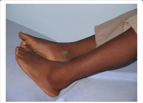Figure 2 Rheumatoid factor negative (RF-ve) Polyarticular JIAhand deformities in a Zambian Child