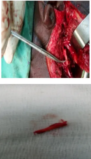 Table 3. Comparison of the two surgical approaches in the management of Eagle’s syndrome