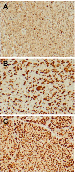Figure 1: Representative IHC images from freshly resected tumor samples.  p53 immunohistochemistry was performed  with the Associated Regional and University Pathologists, Inc