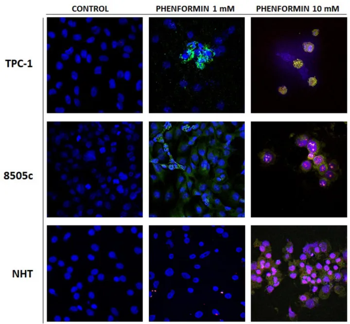 Figure 2: Apoptosis induced in treated thyroid cancer cell lines observed with Annexin V-FITC/PI stain under  confocal fluorescent microscope (40× magnification)