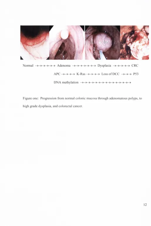 Figure one: Progression from normal colonic mucosa through adenomatous polyps, to 