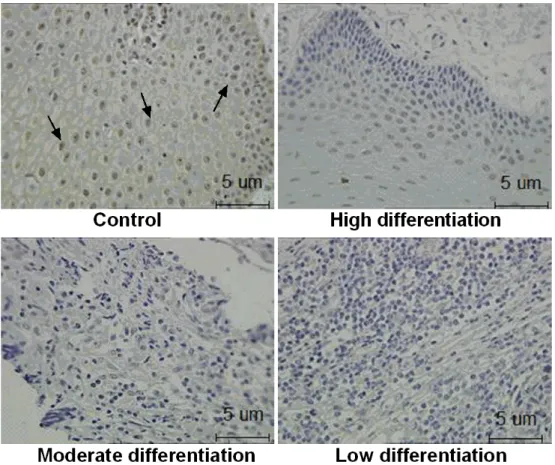 Figure 1: The expression of ZNF750 in OSCC tissues.  The ZNF750 protein expression was investigated by immunohistochemistry