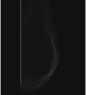 Fig 8.5 Final Gradient Image Generation                                                             Fig2.6 Over-segmentation problem 
