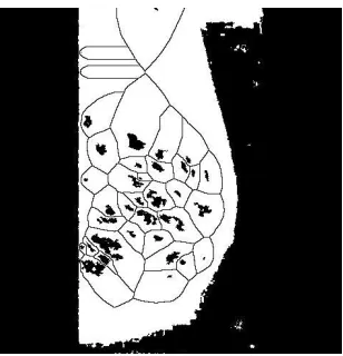 Fig 8.11 detection of microcalfications   on the original image (Segmented image).  