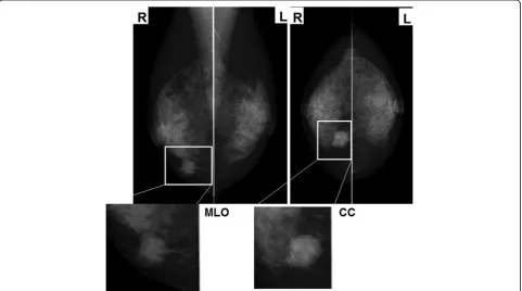 Fig. 1 Mammography showing a shadow of an intense irregular mass in the inferior medial region of the right breast