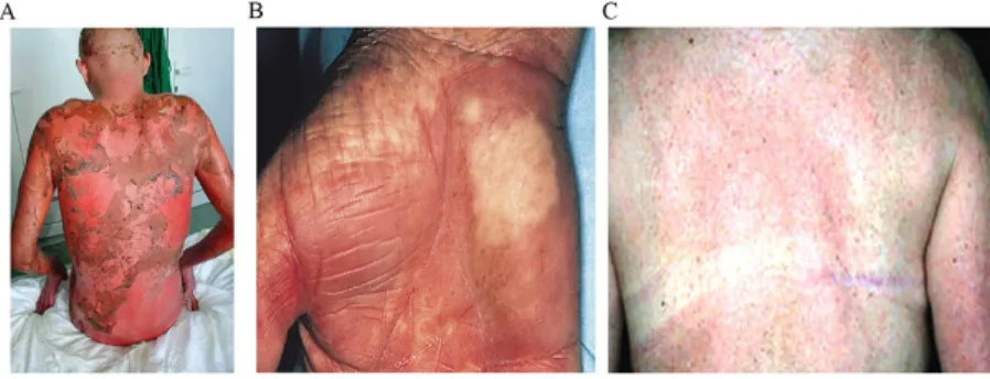 Figure 1: (A) Acute stage IV GVHD, following a myeloablative conditioning chemotherapy