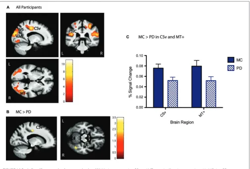 FIGURE 2 | Optic ﬂow (ﬂow > random) group activation. (A) Wholegroup activation in the optic ﬂow network, including V6, V3A, MT+,PIVC, and CSv shown below, p < 0.001, cluster corrected with a 46voxel extent threshold to p < 0.01, at MNI xyz [−17 −34 0]