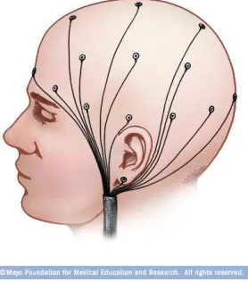 Figure 2.4: Schematic representation of the EEG electrodes placed on the scalp.Image source: www.riversideonline.com