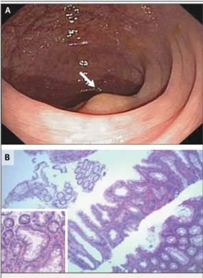Figure 1. Sessile Serrated Polyp.