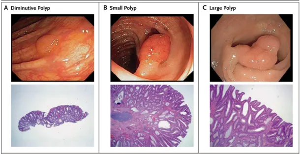 Figure 2. Three Classes of Adenoma According to Size.