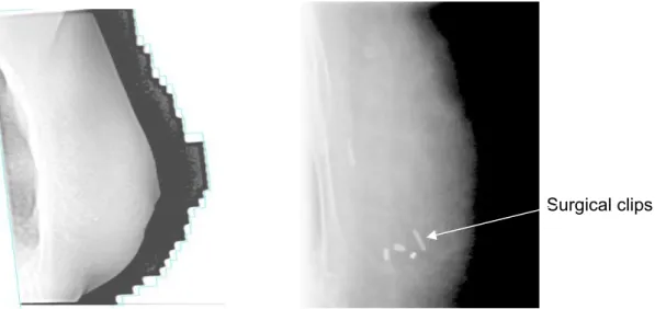 Figure 3. Standard image (left) and low energy x-ray CT image (right) of an IMPORT patient with implanted  surgical clips