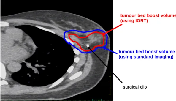 Figure 4. CT image of a patient showing the smaller tumour bed boost dose region for a patient having  image guided radiotherapy (IGRT), outlined in red