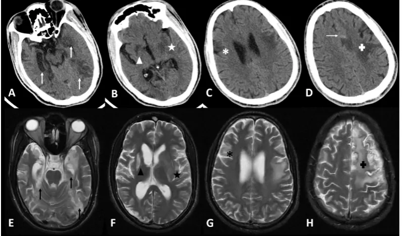 Figure 1: Brain imaging findingsA –D: Axial non-contrast brain CT scan slices showing the ischaemic lesions affecting both temporal lobes (white vertical arrows – A), the right lenticular nucleus (white triangle – B), the left insula and putamen (white sta