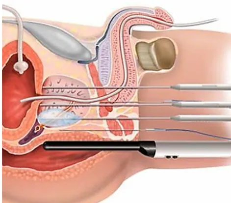 Figure 3. Transperineal approach to prostate biopsy (Avantgarde,2016).