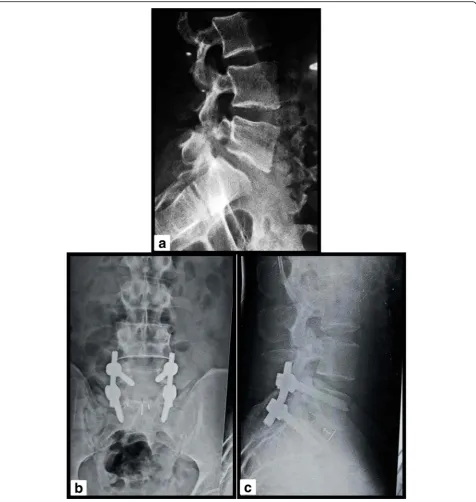 Fig. 2 TLIF procedure for the patient with isthmic L5 S1 spondylolisthesis. a Preoperative X-ray lateral view