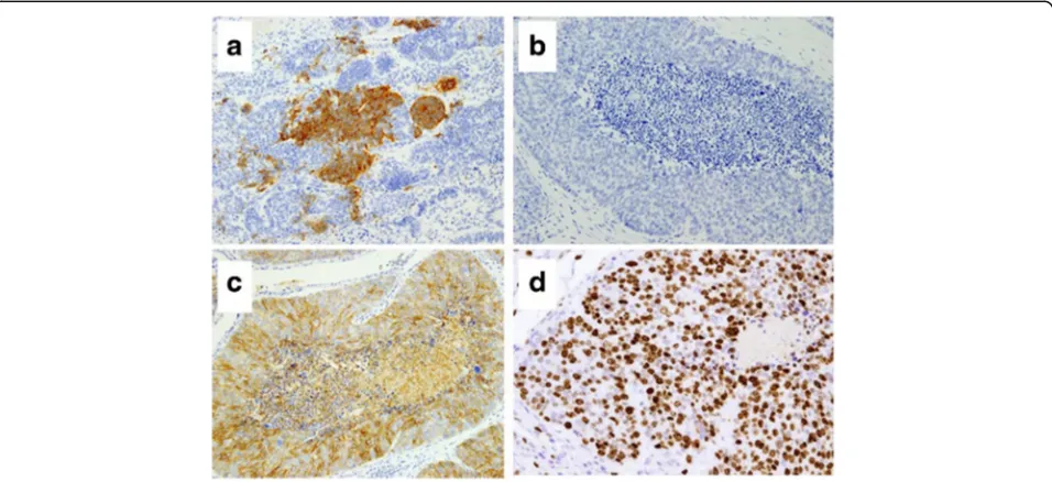 Fig. 5 Immunohistochemical findings in the component of LCNEC. a Immunostaining for synaptophysin was partially positive