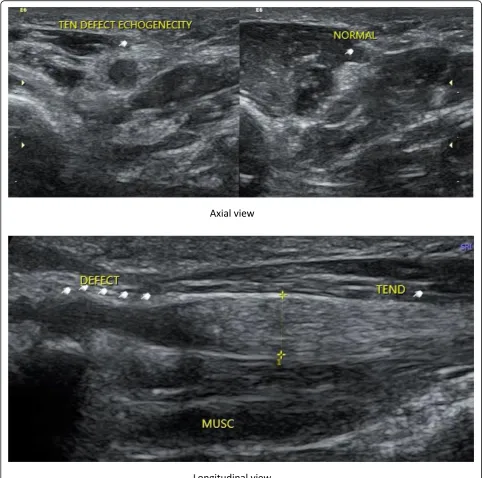 Fig. 2 Female patient 32 years with a history of cut wound at thenar area from 3 months
