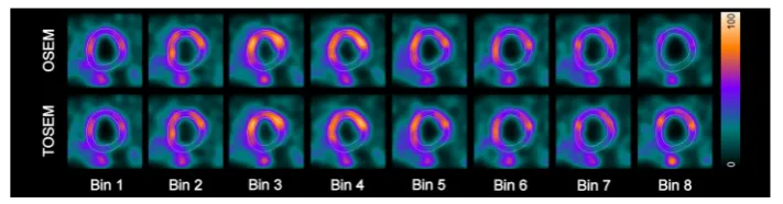 Fig. 1 Short axis views of ECG-gated patient SPECT data reconstructed with OSEM and TOSEM algorithmsas displayed by Quantitative Gated SPECT 2012 program
