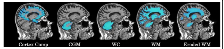 Fig. 1 Different ROIs used for the quantification of 18F-AV-45 PET. From left to right: cortex compositeregion, CGM, WC, WM, and eroded WM ROIs