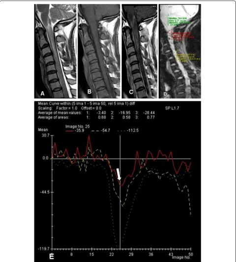 Fig. 1 Thirty-seven-year-old male patient presented by acute onset of bilateral lower limb weakness and neck pain.enhancement.abnormal T2 hyperintense signal spanning over the cervicomedullary junction till CV4 level