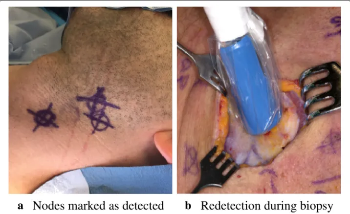 Fig. 1 Two consecutive intervention steps of the current SNB procedure: a prior to the intervention, lymphnodes are localized and hand-marked accordingly