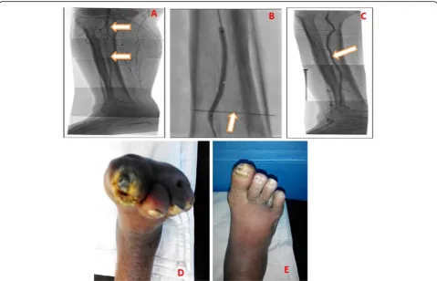 Fig. 5 A 56-year-old male patient presented with unhealed Rt. foot ulcer affecting mainly the big toe: a Pre-procedure angiogram, lateral viewwhere the two arrows indicate the markedly stenosed segment of peroneal artery