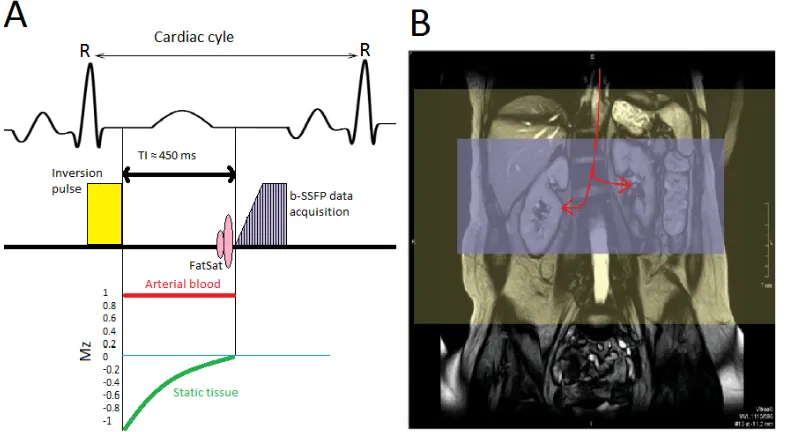 Figure 2.1: A = schematic explanation of the inﬂow enhancement. After the 180◦ inversionpulse, the longitudinal magnetization (Mz) for all tissues within the volume of the pulse(yellow) are negative