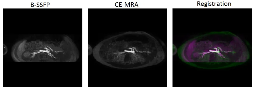 Figure 3.1: Result of the alignment and translational registration of the CE-MRA (moving)with the b-SSFP sequence (ﬁxed) of patient 1