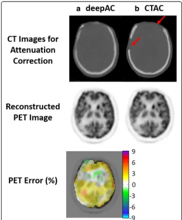 Fig. 6 PET reconstruction using80-year-old female with a significant right and frontal skull abnormality