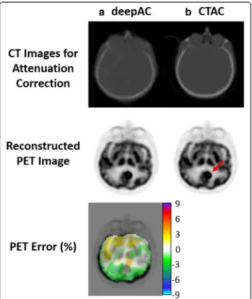 Fig. 7 PET reconstruction usingyear-old male with a brain tumor. The tumor region was indicated by a red arrow in CTAC PET image