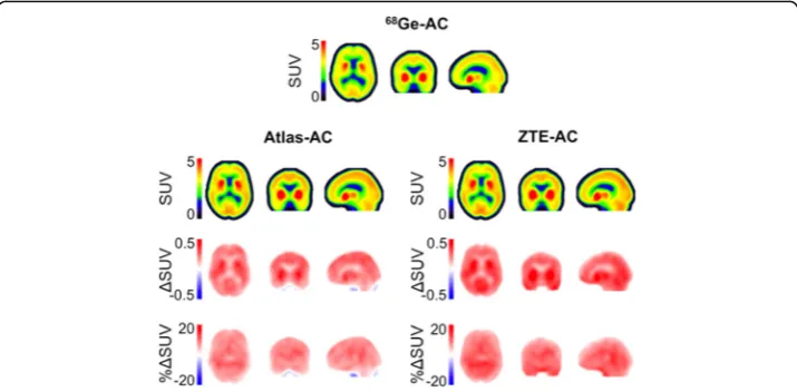 Fig. 1 First row, left to right—68Ge-, Atlas- and ZTE-attenuation correction (AC) maps; Second row—11C-PE2IPET images based on corresponding AC maps expressed as standardised uptake values (SUV)