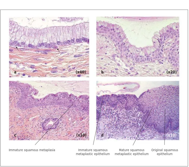 FIGURE 1.5: Development of squamous metaplastic epithelium