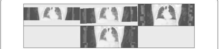 Fig. 5 Example patient original and combined-CT images. The registered original CT images from the early(top left), mid (top middle) and late (top right) study sections and the resulting combined-CT for the latesection (bottom middle) for an example patien