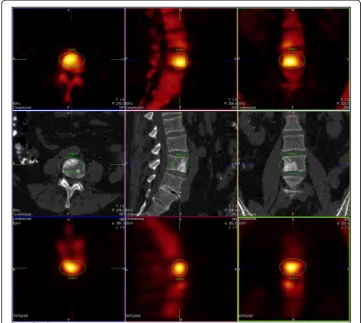 Fig. 4 Reduction of false negative reads with xB. Here, a clearly visible lesion, read as benign by tworeaders in F3D, and as malign by all readers in xB, with confirmation by CT
