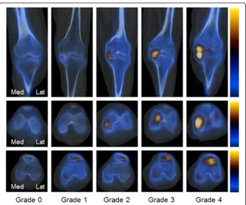 Fig. 2 Kim et al. demonstrated a strong correlation between quantitative bone SPECT results and resultsfrom visual grading for patients with osteoarthritis of the knee (Kim et al