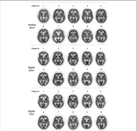 Fig. 4 Gallery of axial brain(upper row), with digital PET and either a comparable reconstruction method with 2-mm voxel size ( 18F-FDG PET images obtained with analog PET and a current reconstruction method using a 2-mm voxel size (n = 10)n = 10) (middle row) or a high-resolutionreconstruction method with 1-mm voxel size (n = 10) (lower row)