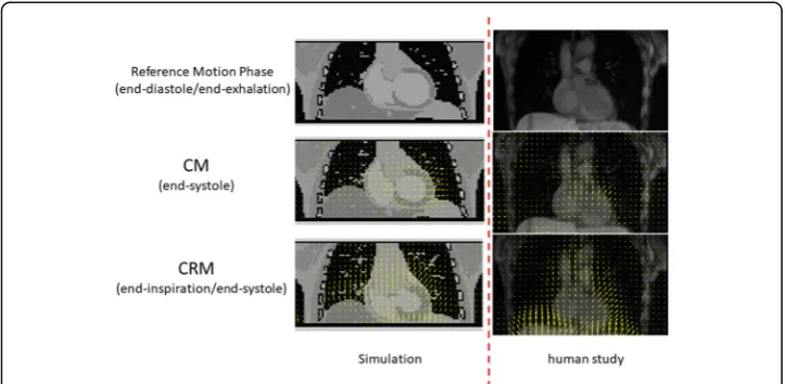 Fig. 4 Coronal MR images for two different motion phases along with the estimated motion fieldsbetween the two motion phases