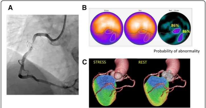 Fig. 6 Highest stress defect score and ischemia determined by ANN and two observers in 79-year-old manwith angina pectoris
