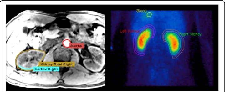 Fig. 1 Left: Schematical illustration of the volumes of interest (VOIs) chosen in the T1 MRI sequence: totalto the chosen part of thekidney region (selected in each layer), cortex region (chosen with a threshold tool in several layers), andaorta (taken fro