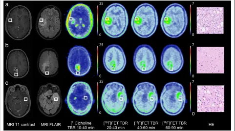 Fig. 1 Examples of [11C] choline and [18F] FET PET scans with biopsy location (green square) and corresponding histology