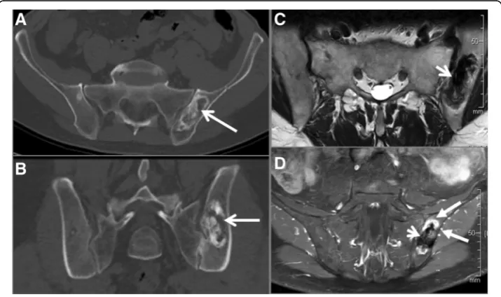 Fig. 1 CT images in transversal (arrows) after application of contrast media (in the left iliac bone with components of fat density (arrows)